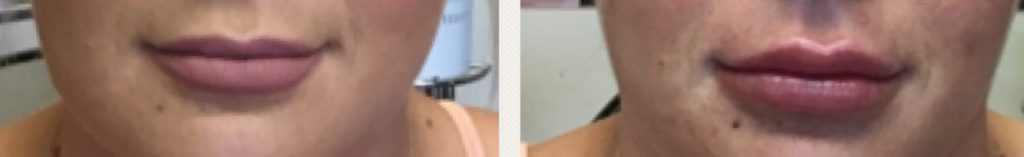 Lips2