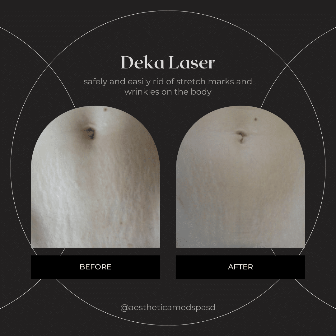 deka_laser-jun23